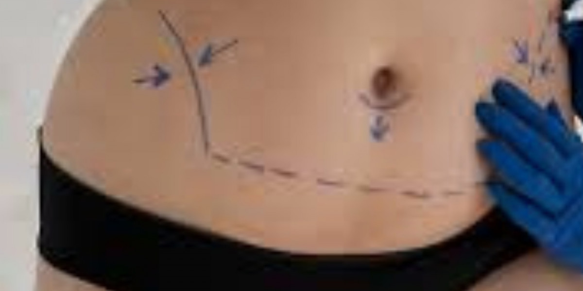 Professional Liposuction Surgery in Istanbul: Step-by-Step Guide and Care